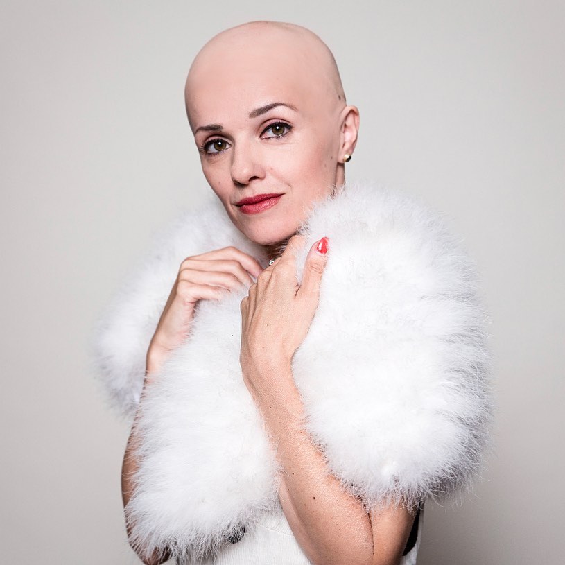 Uitleg over wat haarziekte Alopecia is